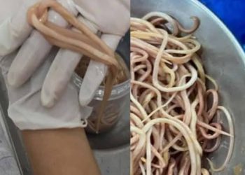 Extraen 142 Lombrices a Niño en Chiapas