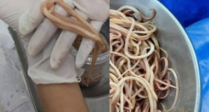 Extraen 142 Lombrices a Niño en Chiapas