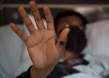 Cuarto caso de Viruela símica en Quintana Roo