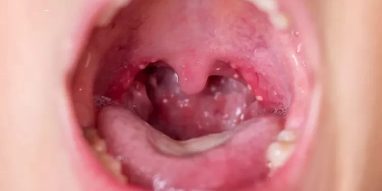 Aumentan los contagios de escarlatina en México este 2025; estados más afectados y síntomas de alerta