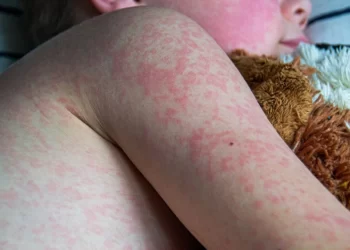 Fallece niño de 8 años por sarampión en Durango; contrajo el virus en Sinaloa
