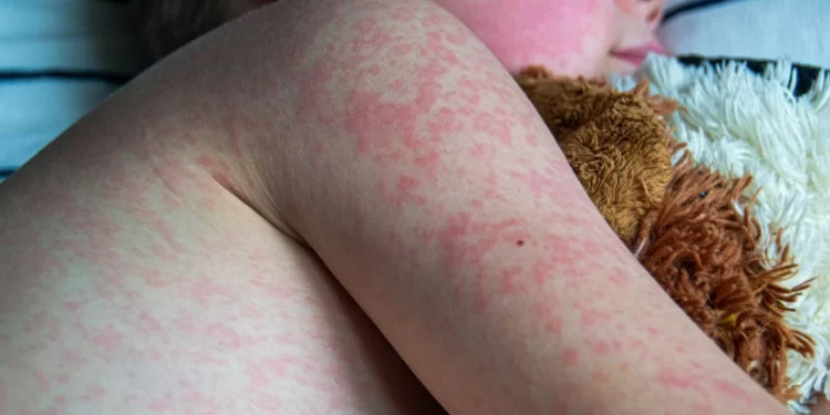 Fallece niño de 8 años por sarampión en Durango; contrajo el virus en Sinaloa