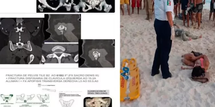 Cancún: turista arrollada por moto acuática podría quedar cuadripléjica